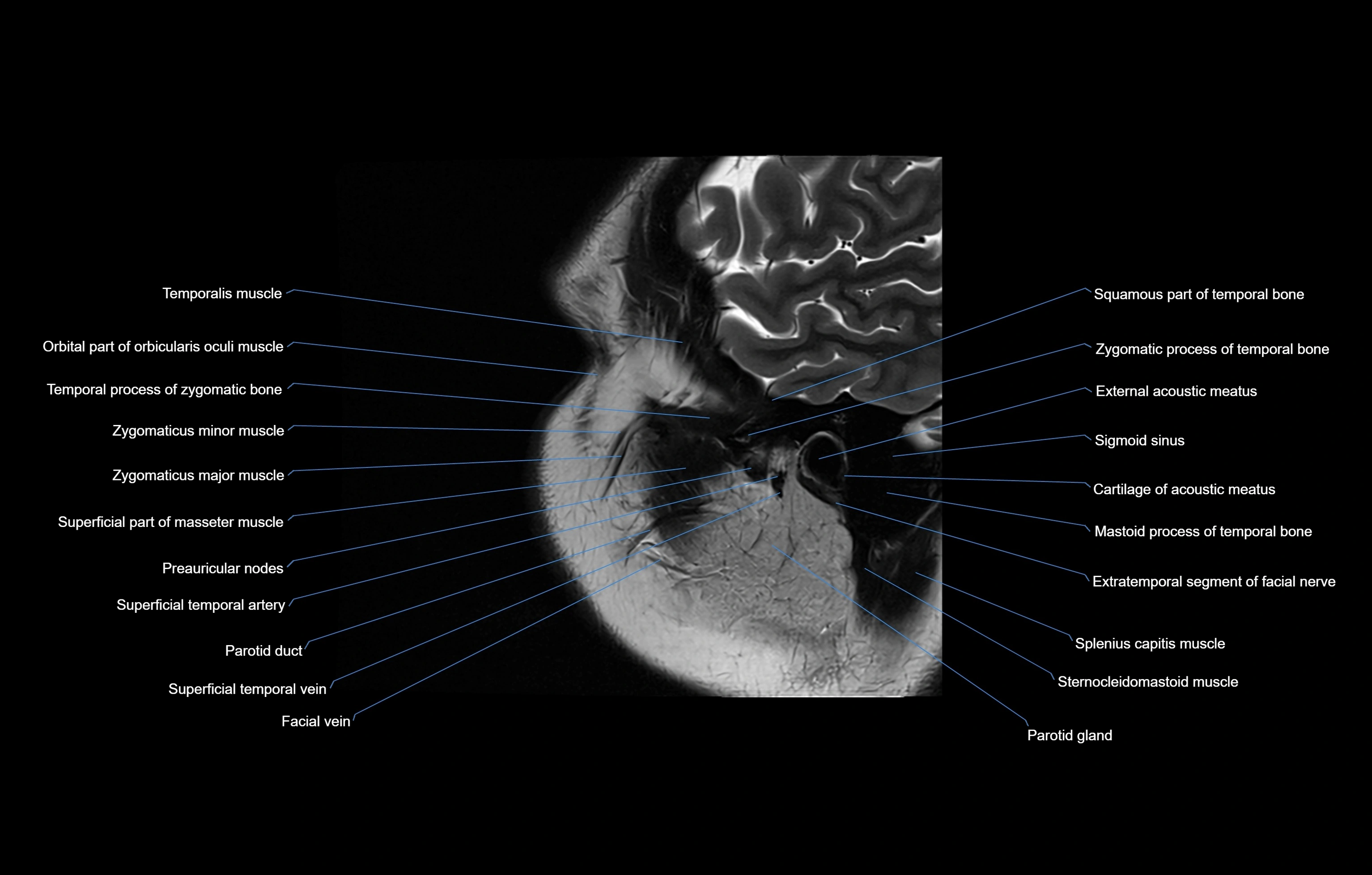 paranasal sinuses(PNS) MRI coronal  cross sectional anatomy 3T radiology  image-img-00001-00022.webp
